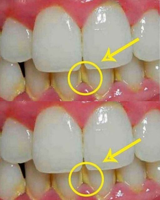 Remove plaque naturally in 5 minutes without going to the dentist