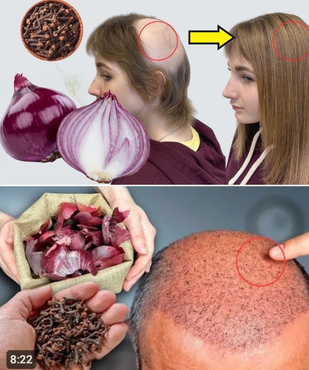 The Surprising Hair Growth Benefits of Cloves and Onion Peels