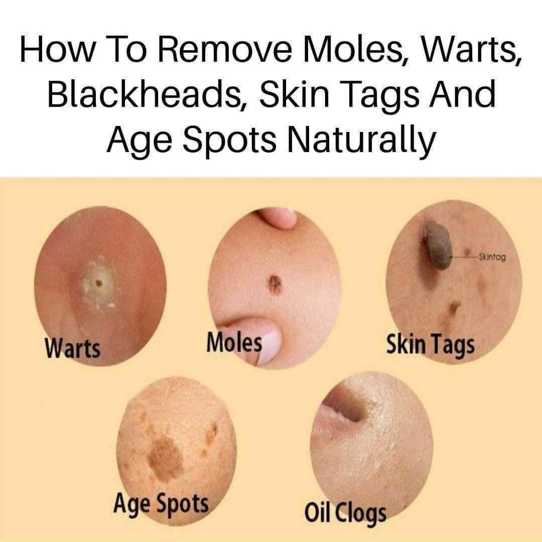 Home remedies for removing age spots, moles, skin tags, warts, and blackheads.