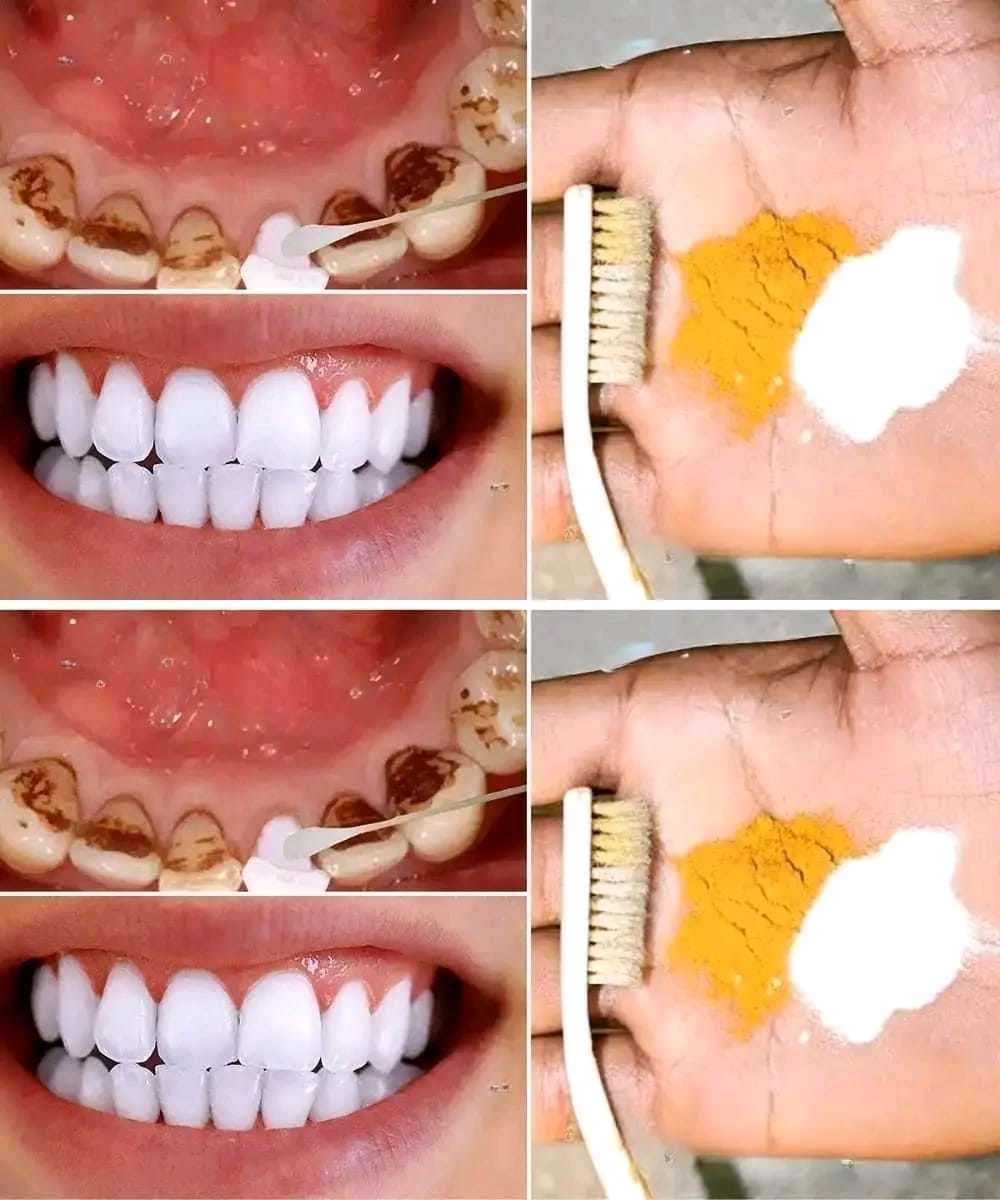 Home Teeth Whitening: Get Whiter Teeth in Just 2 Minutes!