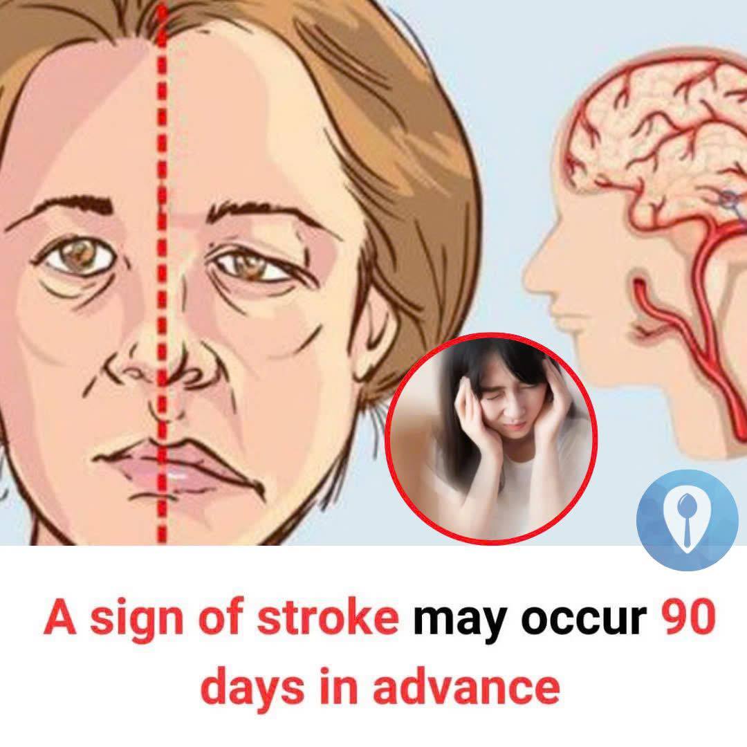 Stroke symptoms can appear very early