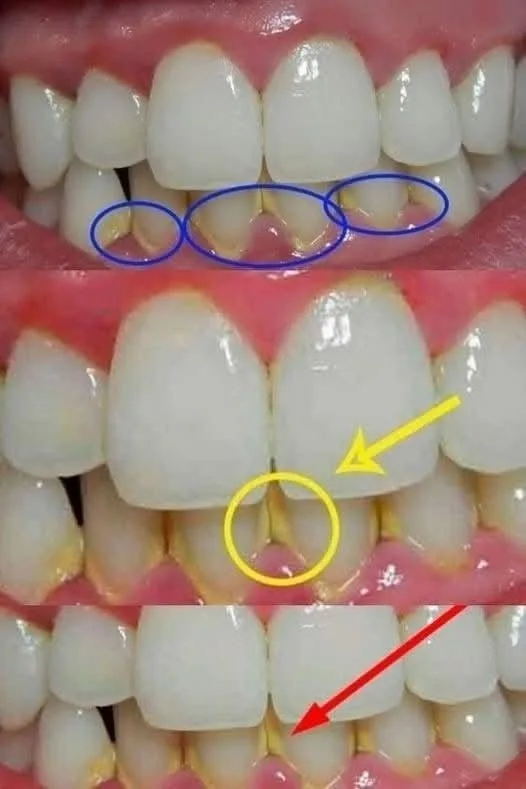 Remove dental plaque in 5 minutes naturally, without going to the dentist.