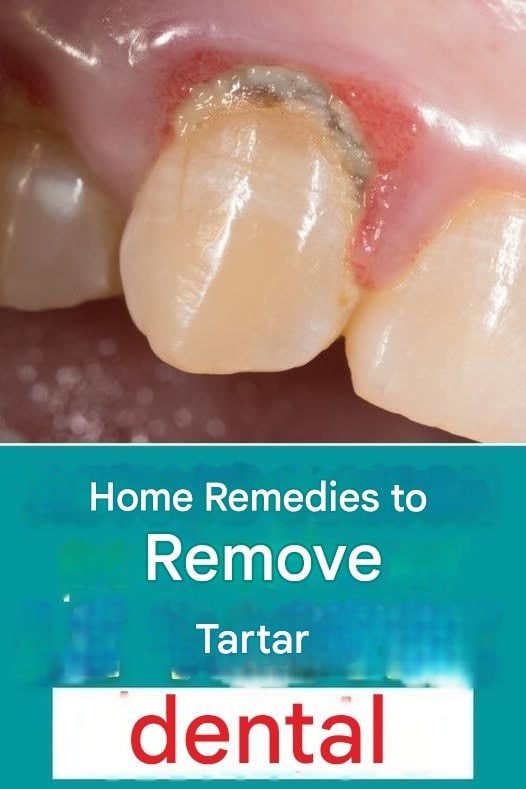 Home remedy to remove tartar yourself