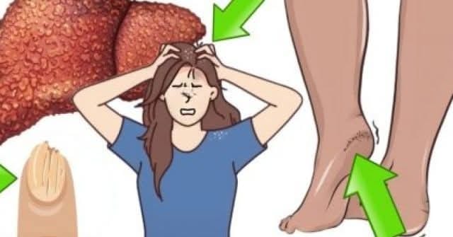 12 Early Signs of Liver Cirrhosis That Require Special Attention from Doctors